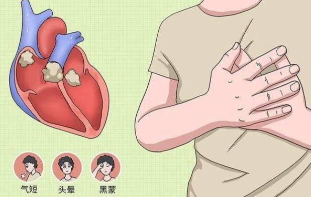 心肌炎是什么病严重吗图片